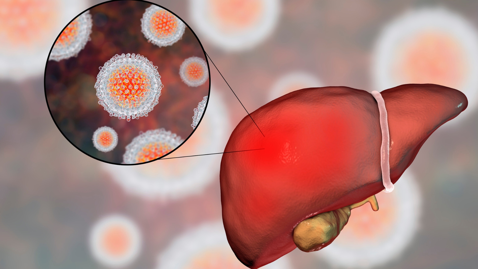 Understanding Hepatitis B